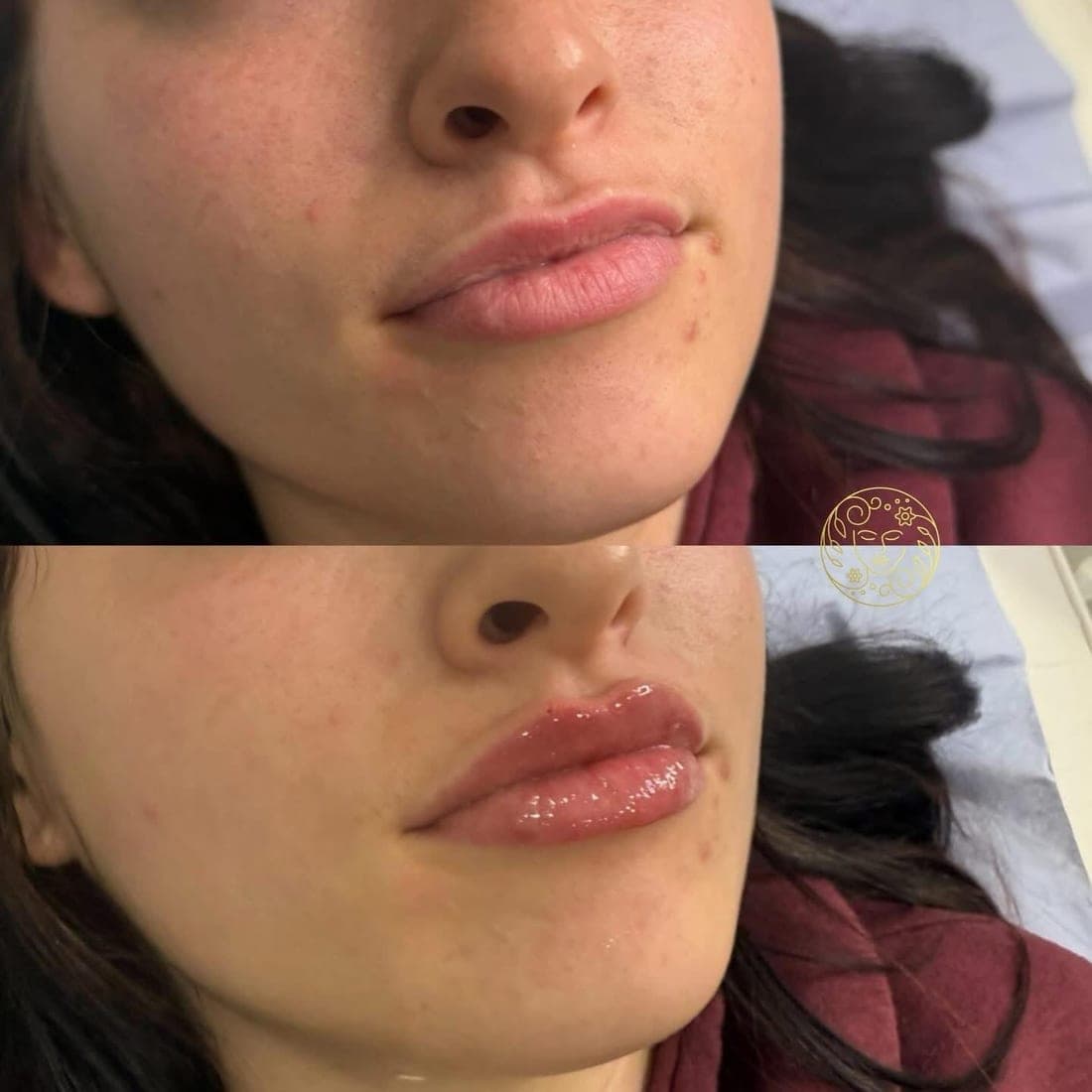 Before and after lip filler, close up of a young woman's lips, subtle and natural